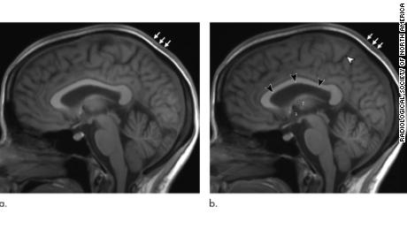 A comparison of an astronaut&#39;s brain before (left) and after long-term spaceflight shows the expansion of brain volume. 