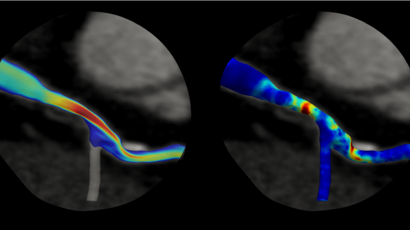 Noninvasive Modeling Technology Aims to Better Assess Risk of Heart Attack – UT News | The University of Texas at Austin