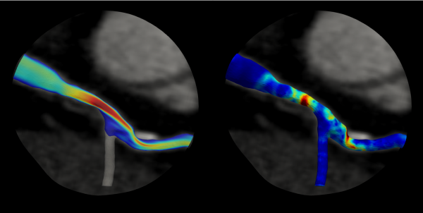 Noninvasive Modeling Technology Aims to Better Assess Risk of Heart Attack – UT News | The University of Texas at Austin